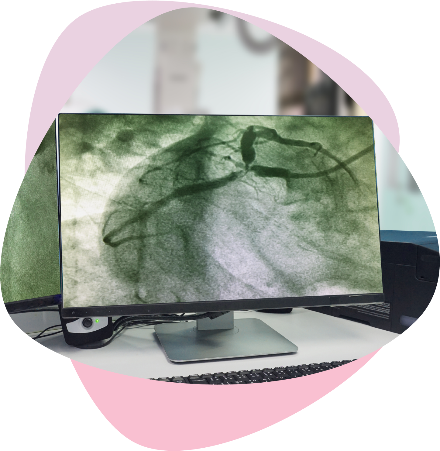  Coronary angiogram (CAG) displayed on monitor