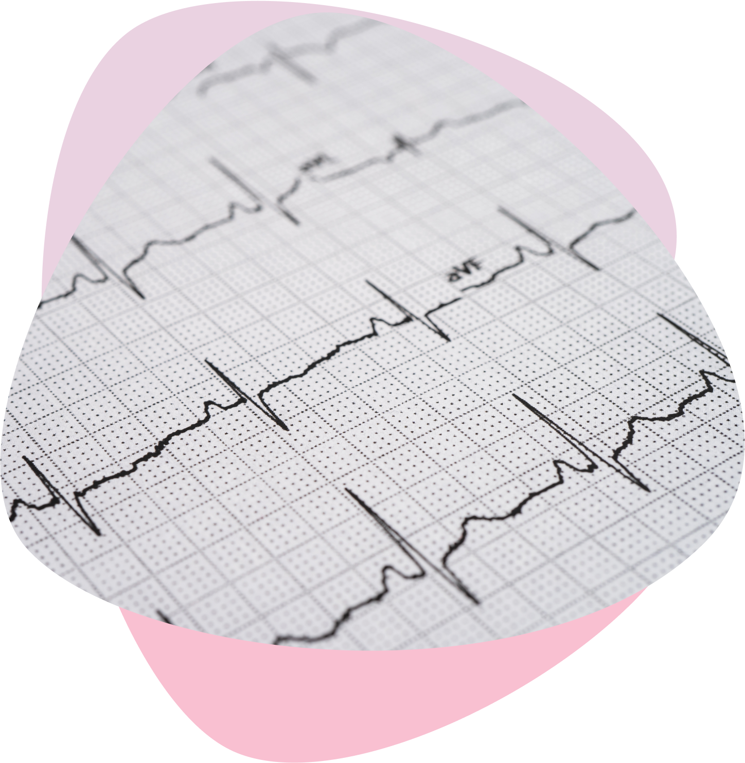 Catheter used for coronary angiography