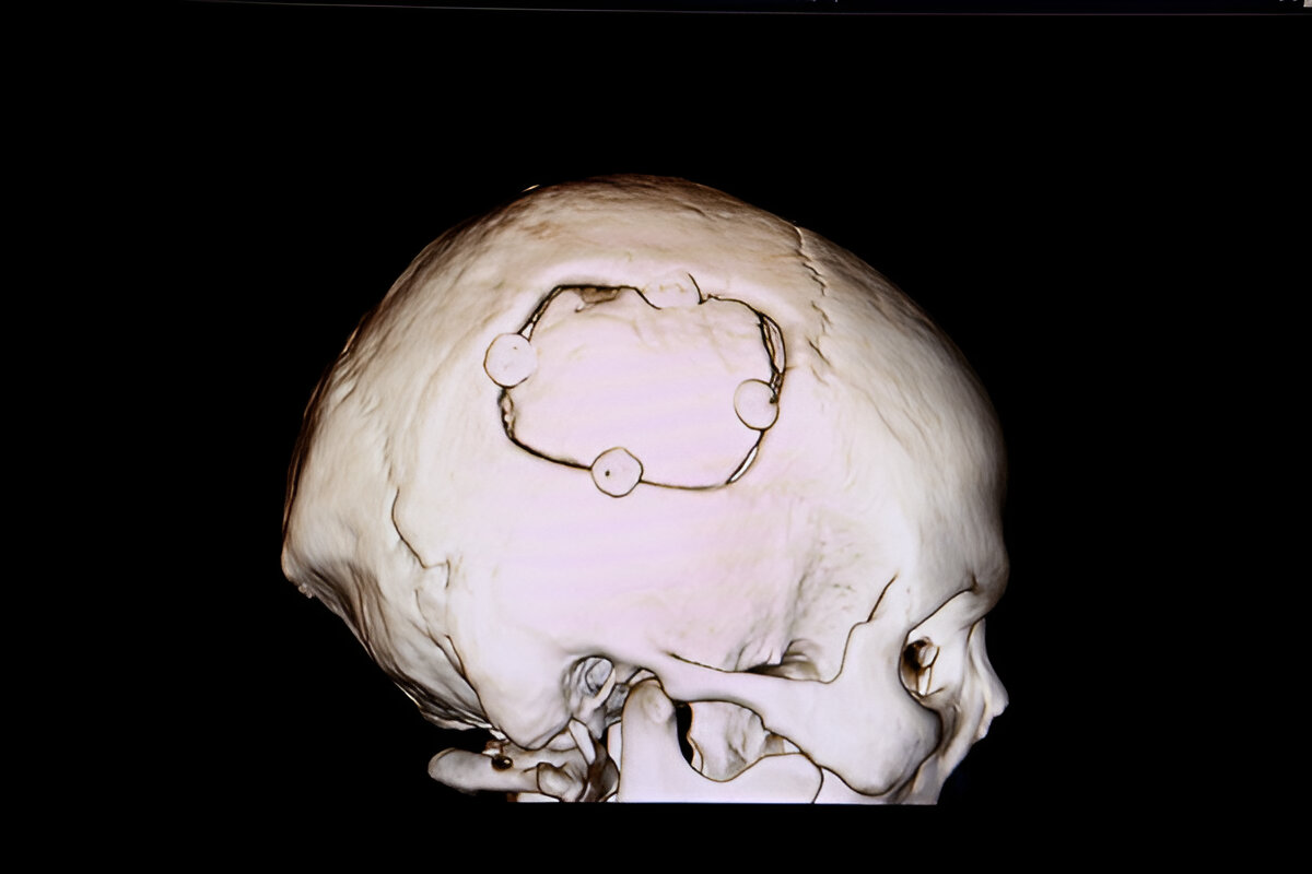 3D redering of a skull