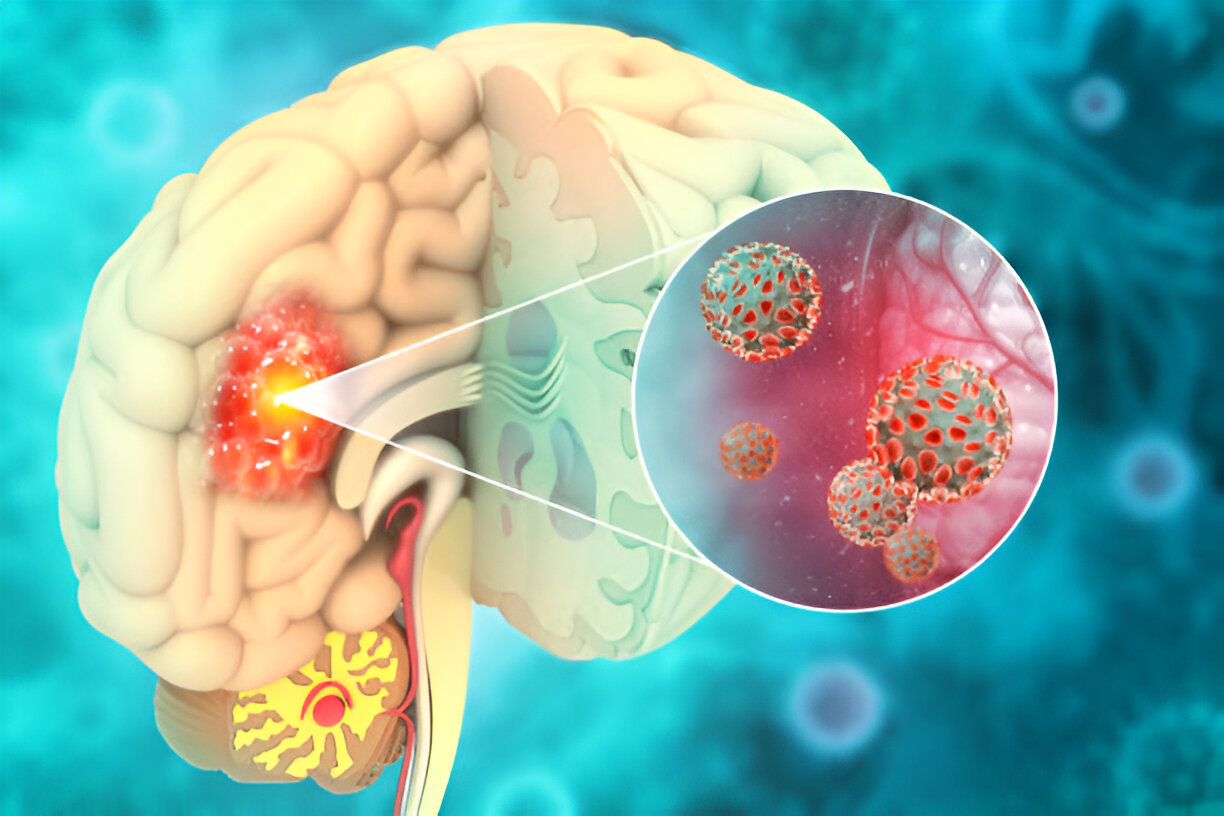 Image of brain with a visible tumor inside