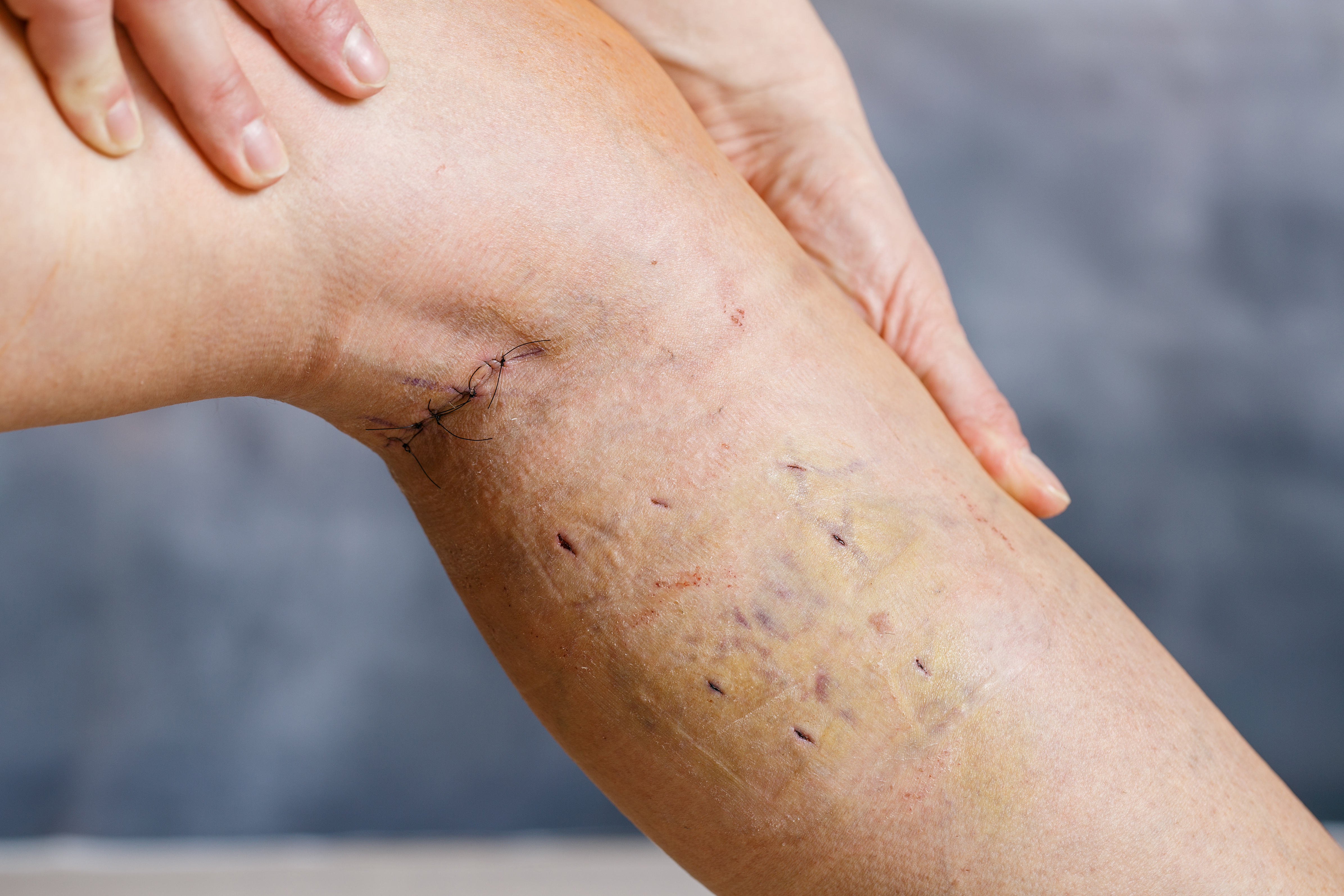  Woman’s leg after varicose vein surgery
