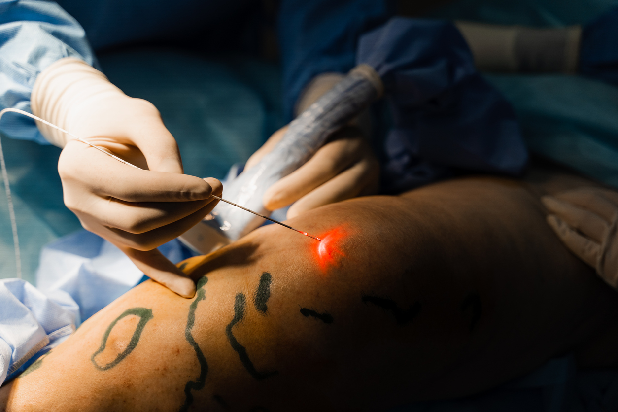 Doctor performing endovenous laser coagulation to treat varicose veins