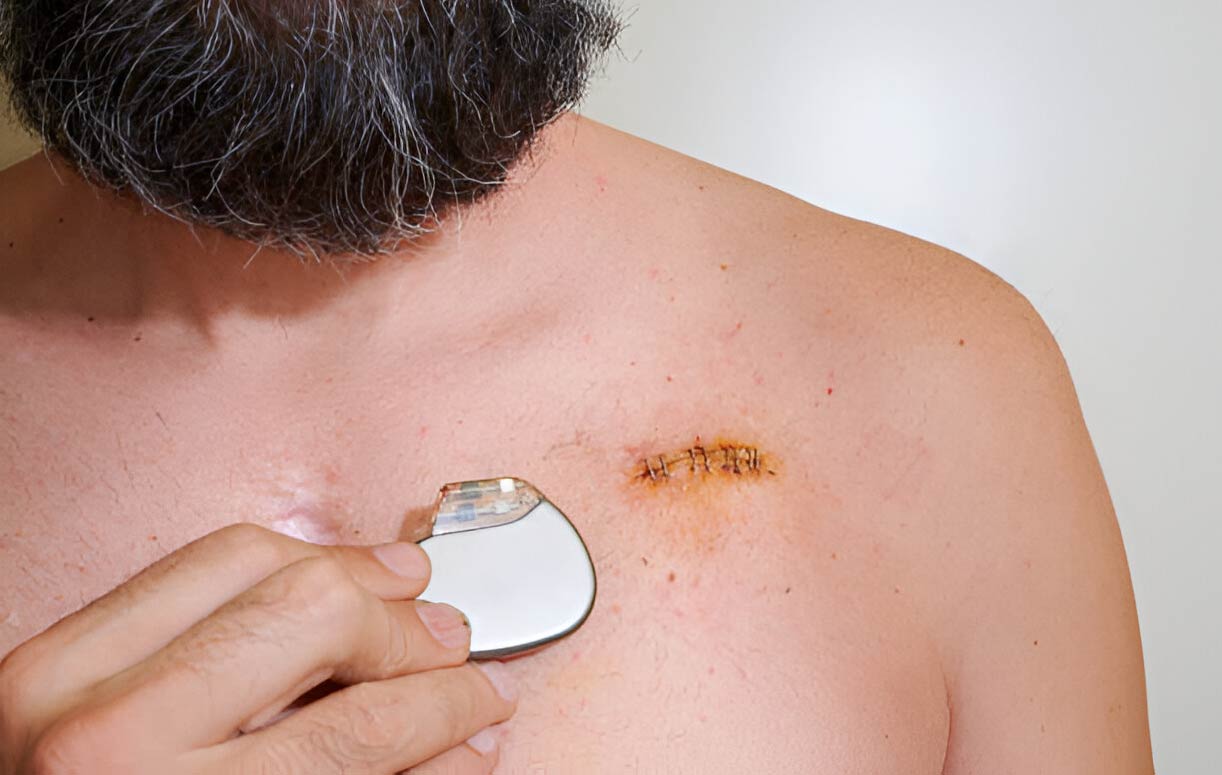 10 Things You Need to Know When Living with a Pacemaker