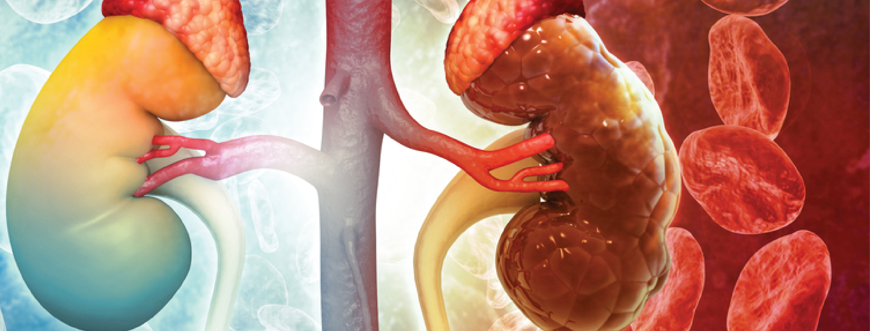 3d illustration of chronic kidney disease