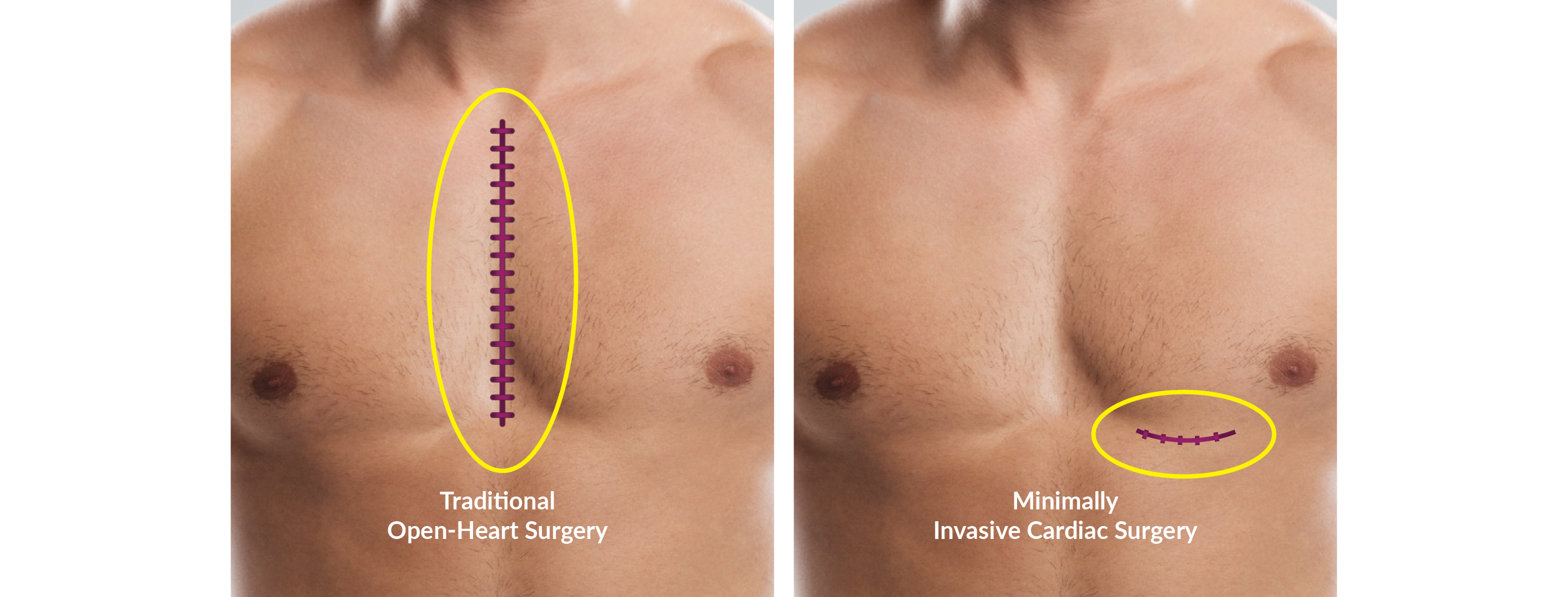 Traditional open heart surgery vs MICS